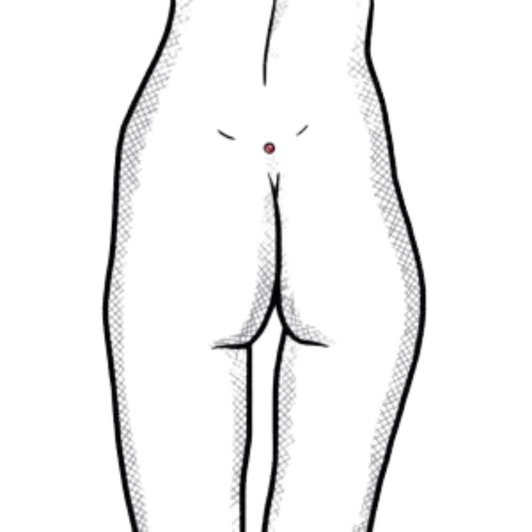 Steissbein Implantat Butt Cheek